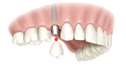 Single Dental Implants Hollis