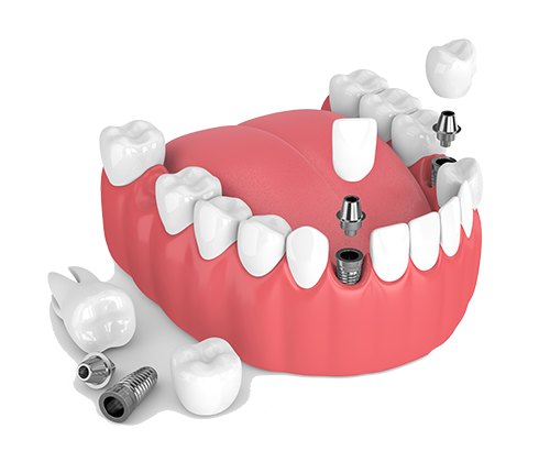 Multiple Teeth Dental Implants in Hollis